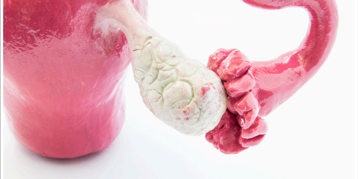 Polycystic ovary syndrome (PCOS) - IvanaMd