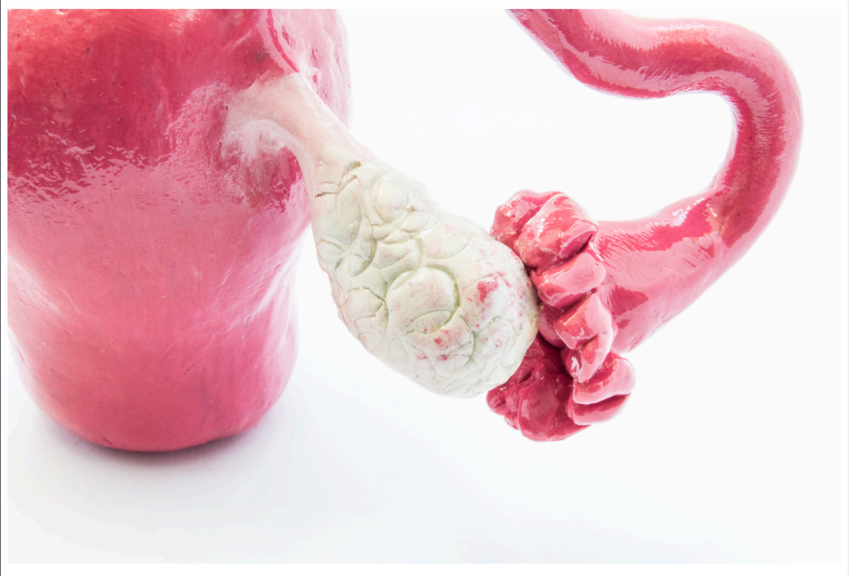 Polycystic ovary syndrome (PCOS) - IvanaMd